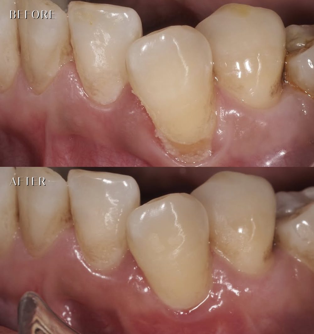 下顎犬齒牙齦萎縮重建 before after