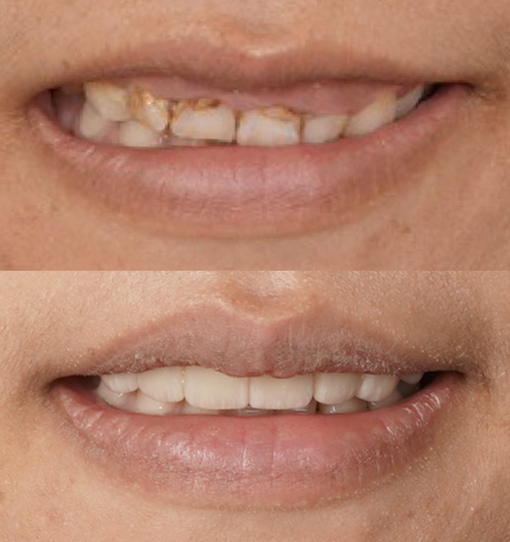美學牙冠增長後的前牙貼片 before after